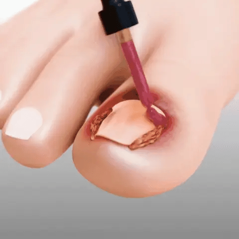 7 Days Nail Fungus Treatment, extracto de jengibre en gotas